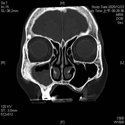 圖3東元綜合醫院耳鼻喉科詹健暘醫師利用鼻竇內視鏡微創手術開擴鼻竇開口徹_ - 報新聞 Mega News